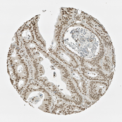IHC of colon cancer cells labeled with DSHB antibody CPTC-ARG1-1 against Arginase 1 Peptide 1. Image Credit: NCI-Clinical Proteomic Technologies for Cancer.